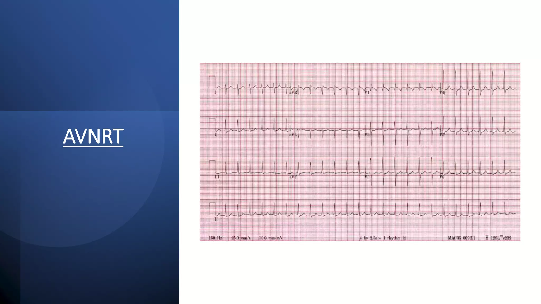 Basic ECG Interpretation.pptx