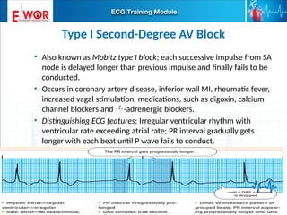 Type I Block Basic ECG interpretation.pptx learn about ecg | PPTX