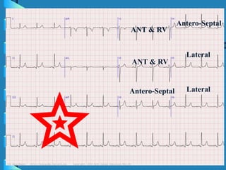 14
ANT & RV
ANT & RV
Antero-Septal
Antero-Septal
Lateral
Lateral
 