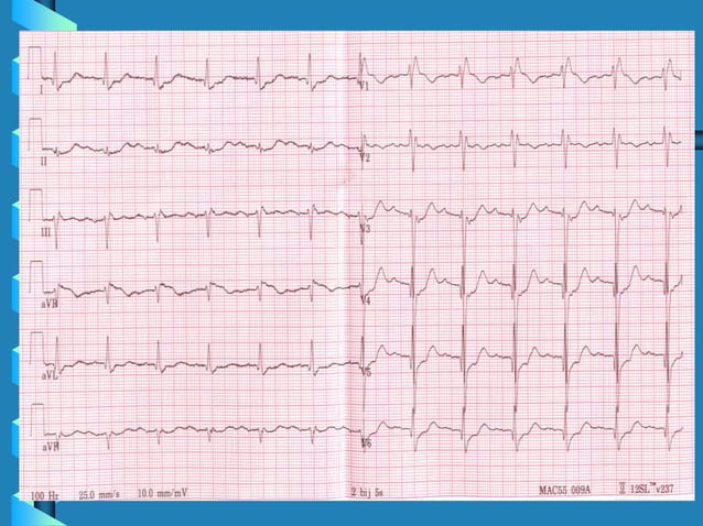 BASIC ECG INTERPRETATION PRESENTATION .ppt | Heart and Cardiovascular ...