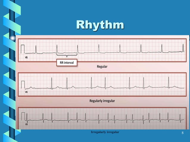 BASIC ECG INTERPRETATION PRESENTATION .ppt