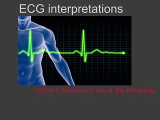 ECG interpretations
JUSTIN V SEBASTIAN, MSc N, RN, PhD Scholar
 