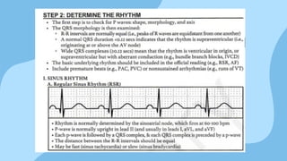 Basic ECG Reading for Level 3 Nursing Students | PPTX
