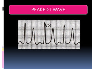 Basic ECG &rhythm interpretation | PDF