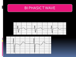 Basic ECG &rhythm interpretation | PDF