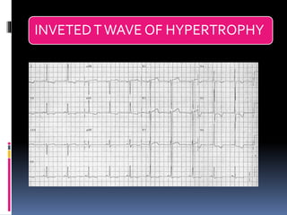 Basic ECG &rhythm interpretation | PDF