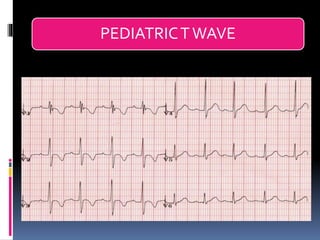 Basic ECG &rhythm interpretation | PDF