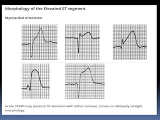 Basic ECG &rhythm interpretation | PDF