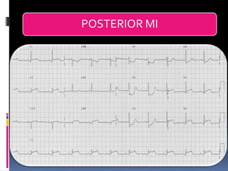 Basic ECG &rhythm interpretation | PDF
