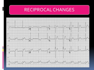Basic ECG &rhythm interpretation | PDF