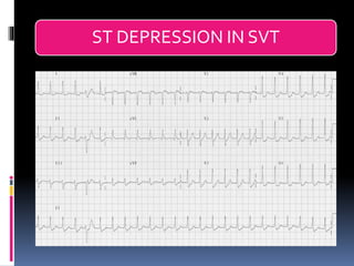 Svt Depression Basic ECG &rhythm interpretation | PDF