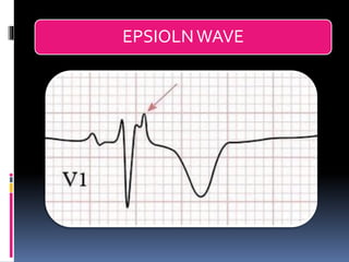Basic ECG &rhythm interpretation | PDF