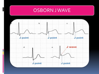 Basic ECG &rhythm interpretation | PDF