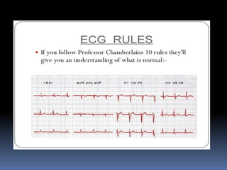Basic ECG &rhythm interpretation | PDF
