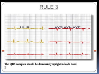 Basic ECG &rhythm interpretation | PDF