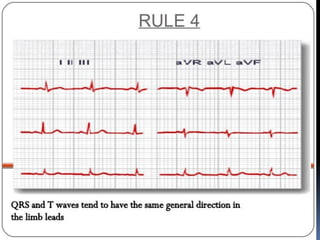 Basic ECG &rhythm interpretation | PDF