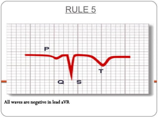 Basic ECG &rhythm interpretation | PDF