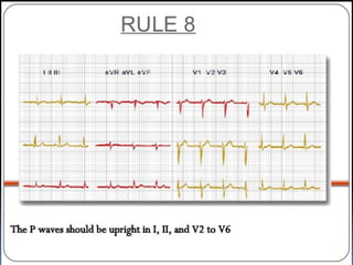 Basic ECG &rhythm interpretation | PDF