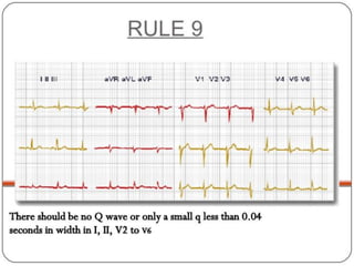 Basic ECG &rhythm interpretation | PDF
