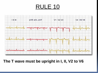 Basic ECG &rhythm interpretation | PDF