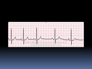 Basic ECG &rhythm interpretation | PDF