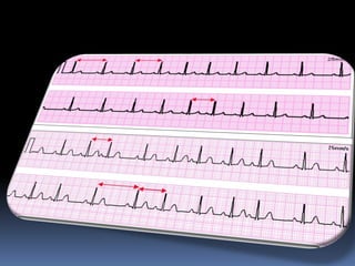 Basic ECG &rhythm interpretation | PDF