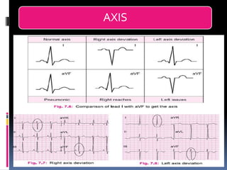 Basic ECG &rhythm interpretation | PDF
