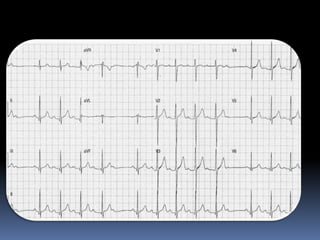 Basic ECG &rhythm interpretation | PDF