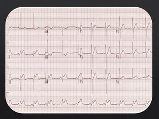 Basic ECG &rhythm interpretation | PDF