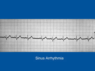 Sinus Arrhythmia 