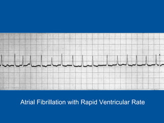 Atrial Fibrillation with Rapid Ventricular Rate 