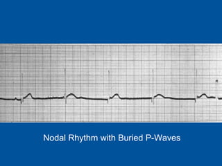 Nodal Rhythm with Buried P-Waves 