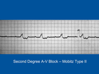 Second Degree A-V Block – Mobitz Type II 