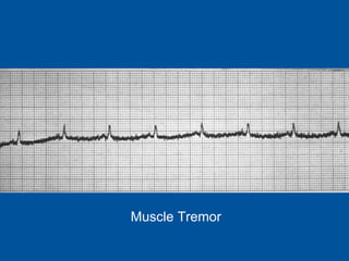 Muscle Tremor 