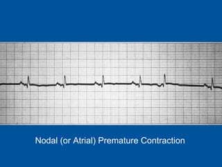 Nodal (or Atrial) Premature Contraction 