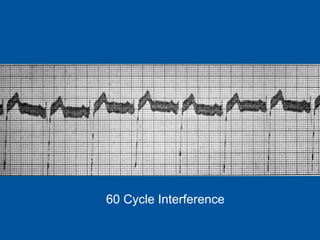 60 Cycle Interference 