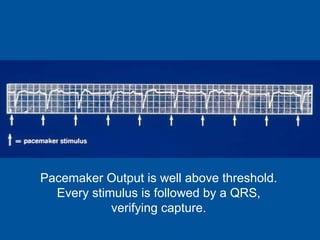Pacemaker Output is well above threshold. Every stimulus is followed by a QRS, verifying capture. 