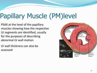Papillary Muscle (PM)level
26
PSAX at the level of the papillary
muscles showing how the respective
LV segments are identified, usually
for the purposes of describing
abnormal LV wall motion
LV wall thickness can also be
assessed
 