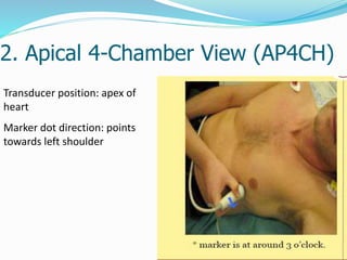 2. Apical 4-Chamber View (AP4CH)
27
Transducer position: apex of
heart
Marker dot direction: points
towards left shoulder
 