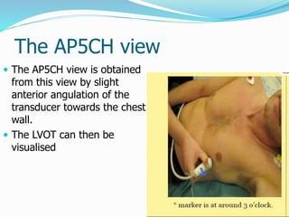 The AP5CH view
 The AP5CH view is obtained
from this view by slight
anterior angulation of the
transducer towards the chest
wall.
 The LVOT can then be
visualised
 