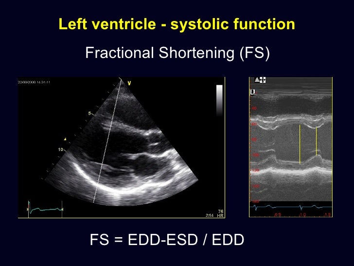 Basic Ecocardiography