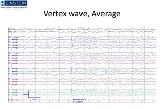 Vertex Wave Basics of EEG - A brief review of the EEG.ppt