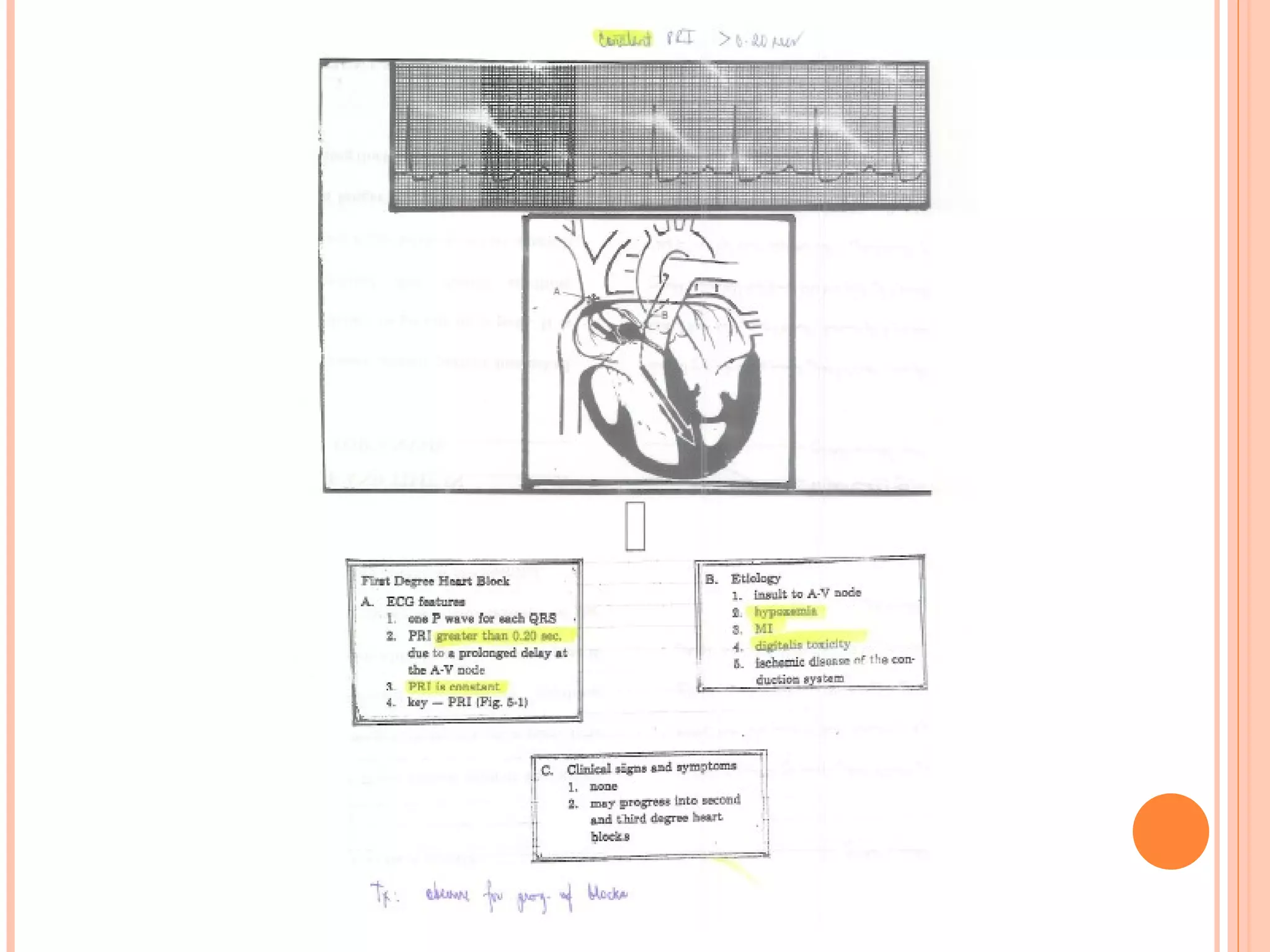 Basic EKG Notes