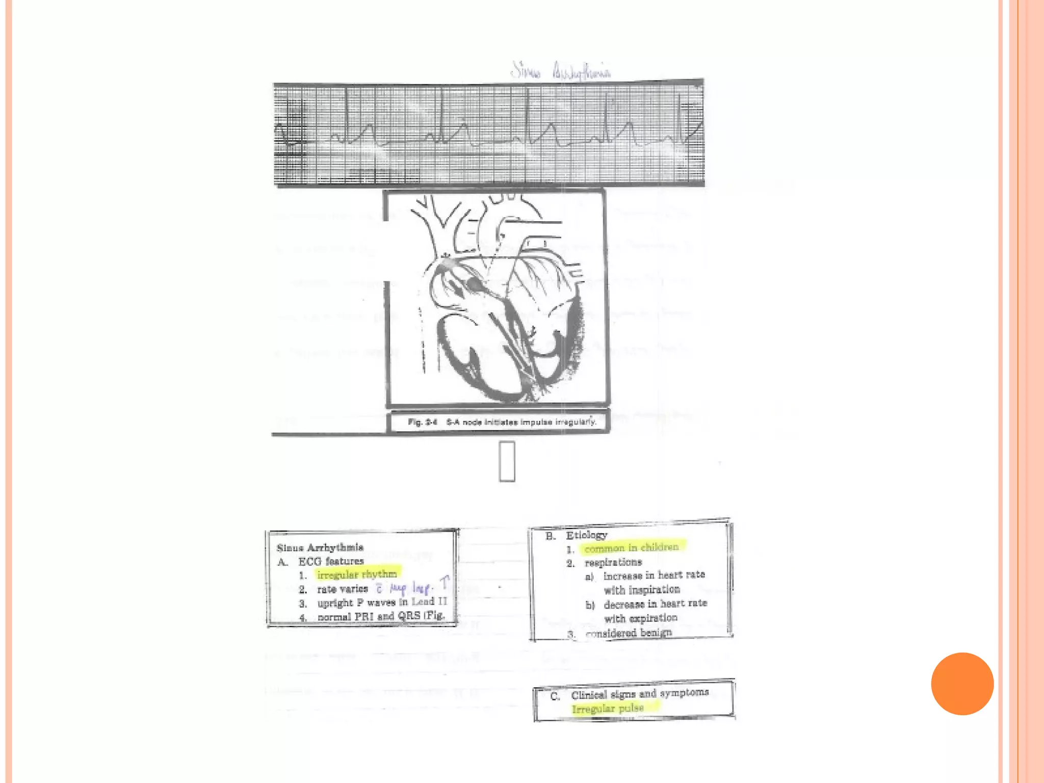 Basic EKG Notes