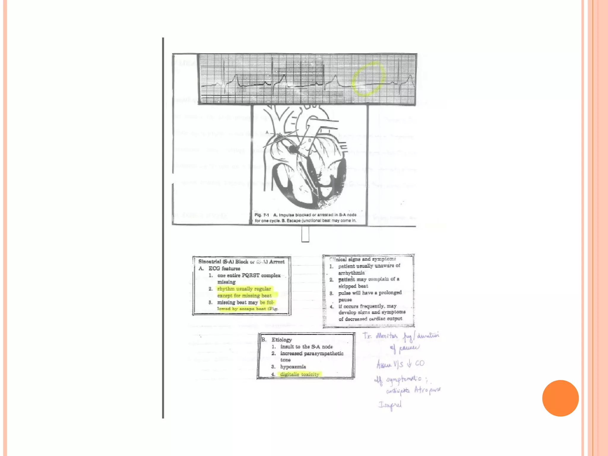 Basic EKG Notes