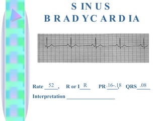 SINUS BRADYCARDIA Rate _____,  R or I____  PR ____,  QRS_____ Interpretation __________________ 52 .16-.18 .08 R 
