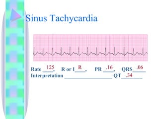 Sinus Tachycardia Rate ____,  R or I____,  PR ____,  QRS_____ Interpretation __________________ QT________ 125 R .16 .06 .34 
