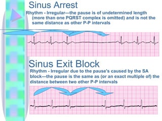 Sinus Arrest Rhythm -  Irregular—the pause is of undetermined length (more than one PQRST complex is omitted) and is not the same distance as other P-P intervals  Sinus Exit Block Rhythm - Irregular due to the pause's caused by the SA block—the pause is the same as (or an exact multiple of) the distance between two other P-P intervals  