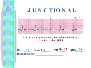 JUNCTIONAL Rate ____,  R or I_____  PR ____,  QRS_____ Interpretation __________________ 53 R .10 -.12 .08 FYI: P can precede, be imbedded in, or after the QRS 