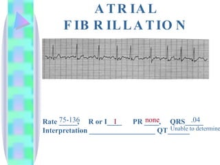 ATRIAL FIBRILLATION Rate _____,  R or I____  PR ____,  QRS_____ Interpretation __________________ QT______ 75-136 I none .04 Unable to determine 
